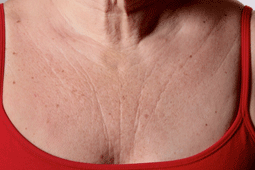 14-chest-wrinkles-9