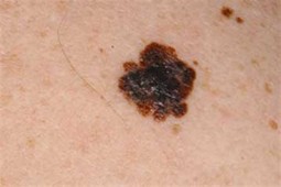 melanoma