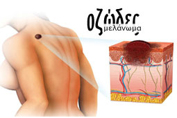 07-ozodes-melanoma-banner-9