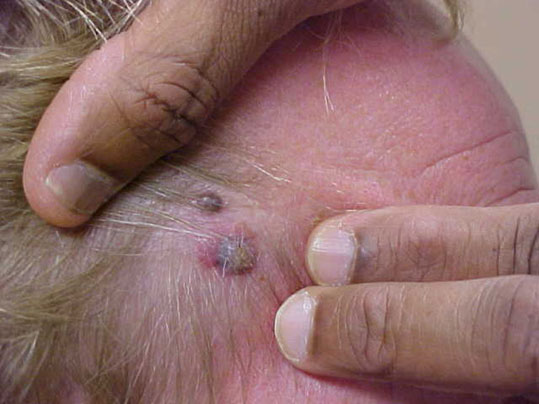 08-ozodes-melanoma-4