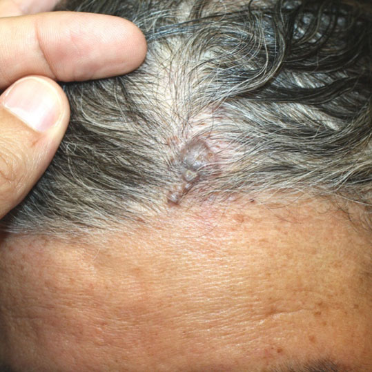 08-ozodes-melanoma