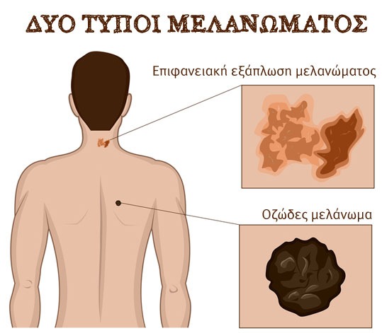 08-ozodes melanoma