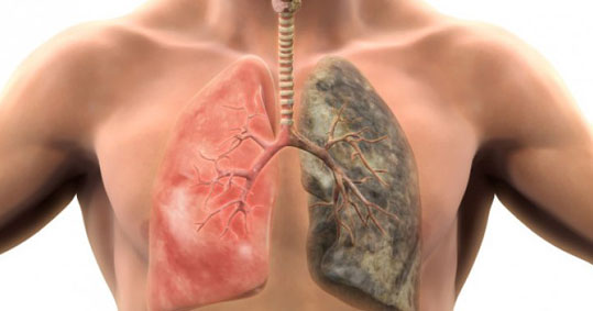 23-pneumones-kapn