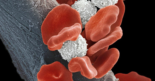 02 -lefhemia