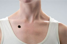 08-melanoma-9