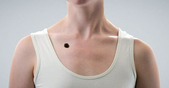 08-melanoma