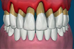 17-periodontitida-9