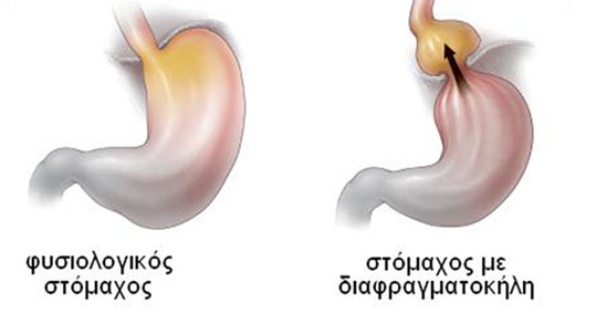 30-diafragma