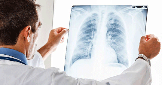 17-pneumonia