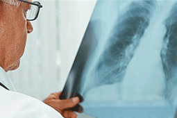 20-pneumonia-9
