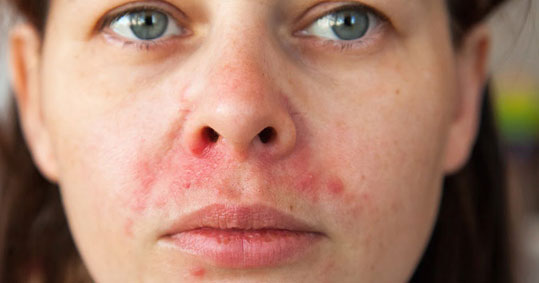 11-dermatitida