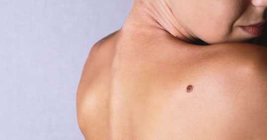 25-melanoma